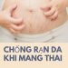 Chống rạn da khi mang thai